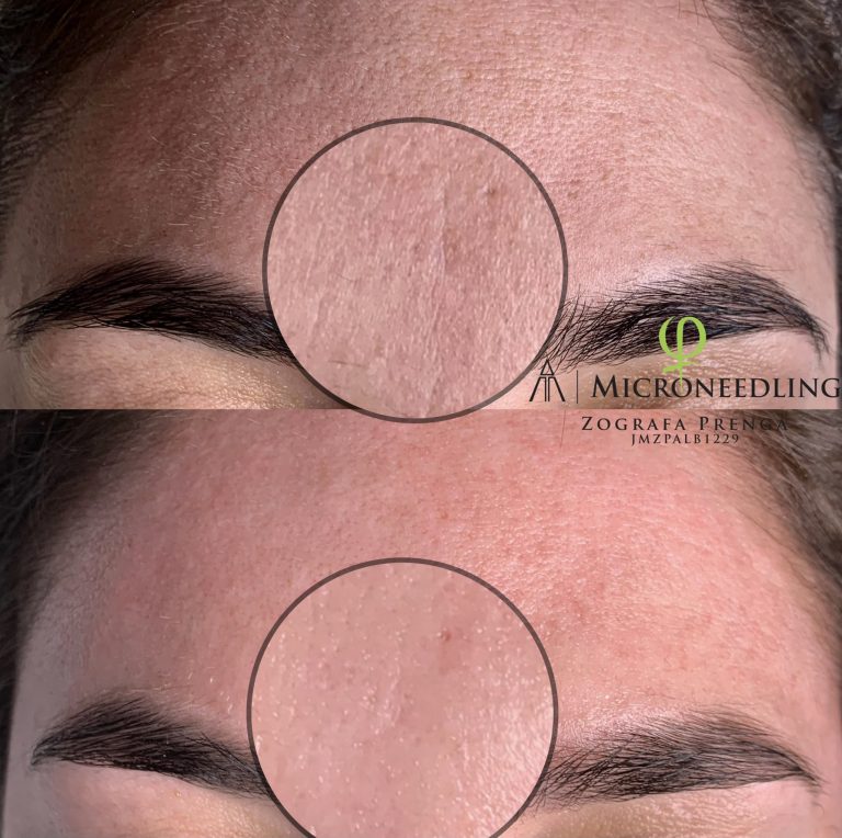microneedling-antes-y-despues