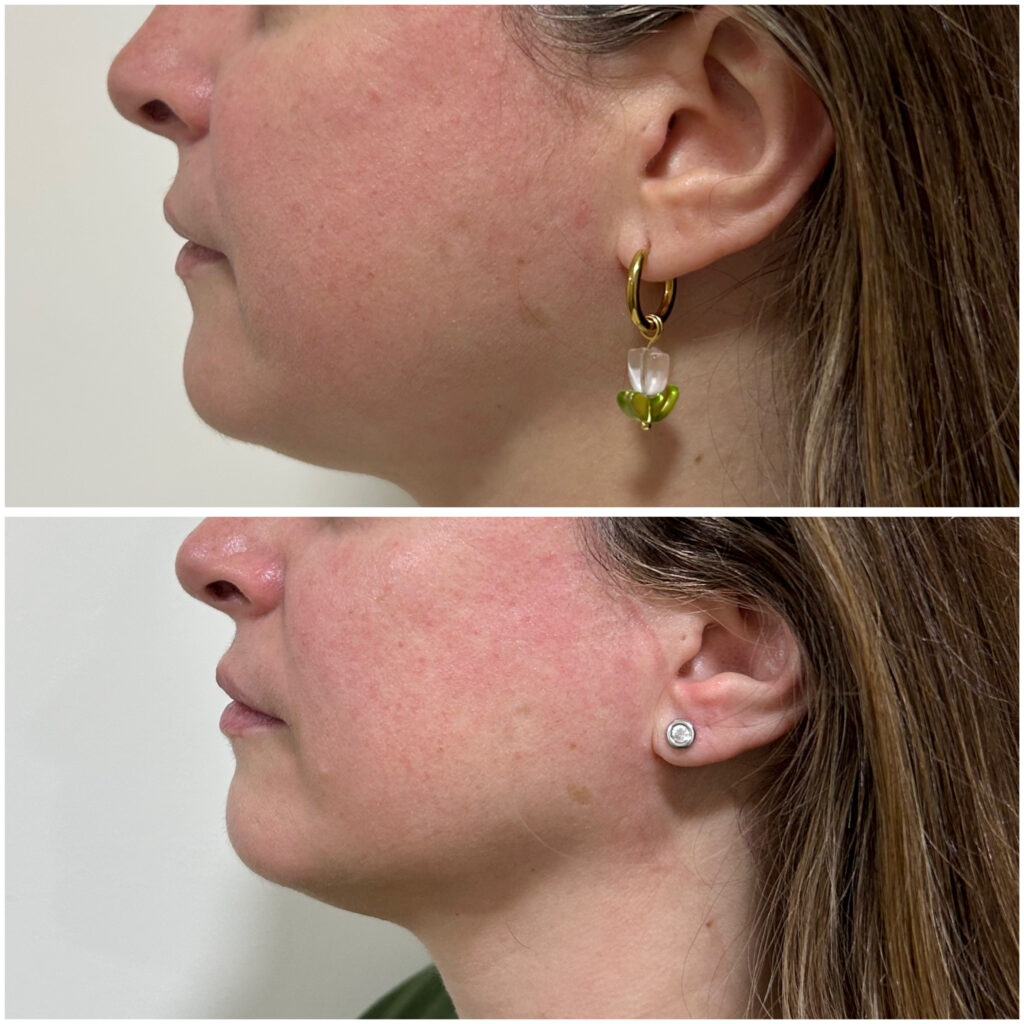 Radiofrecuencia facial 3 AD5A73F0 5AF5 432B 9487 B40C36FE1D5C 1