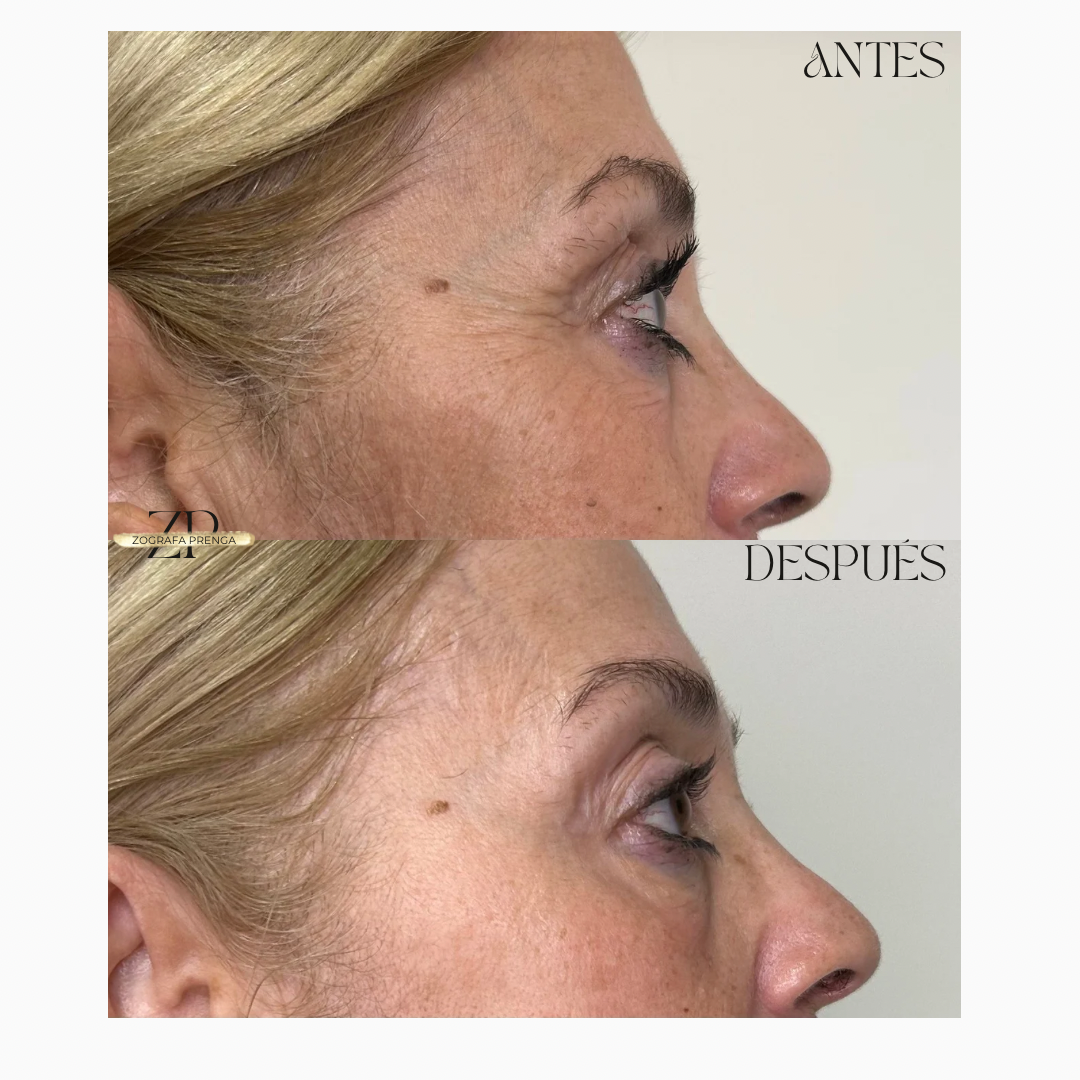 Antes y despues
