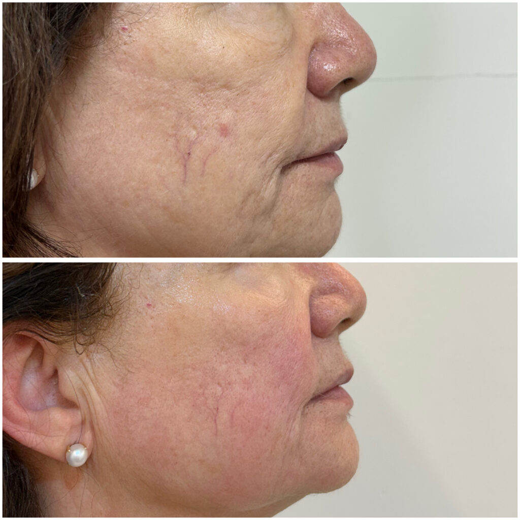 Radiofrecuencia facial 2 FDD7024A 05CB 47EB 8691 78D2FCD0E3AF 3